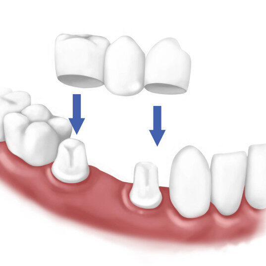 Dental-Bridge-1-Medium