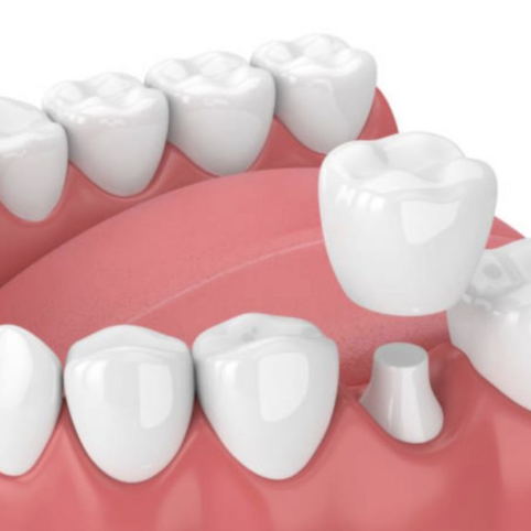 Dental-Crowns-1-Medium