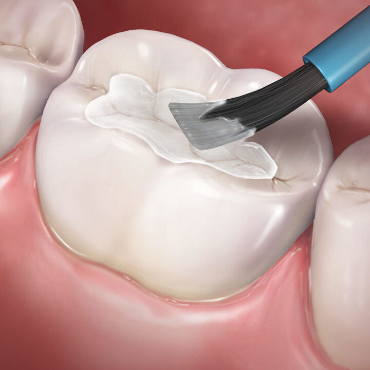 Dental sealants