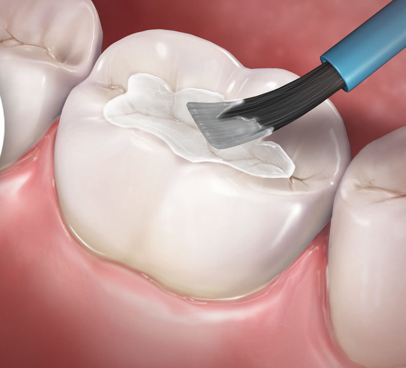 Dental sealants