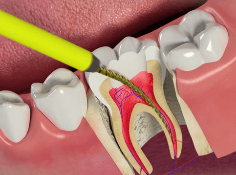 Root canal