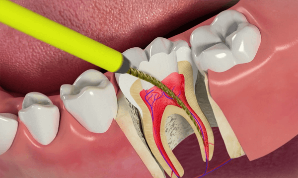 Root canal